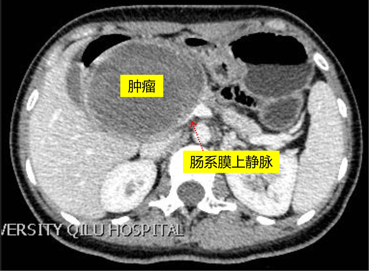 术前CT图片 术前CT图片