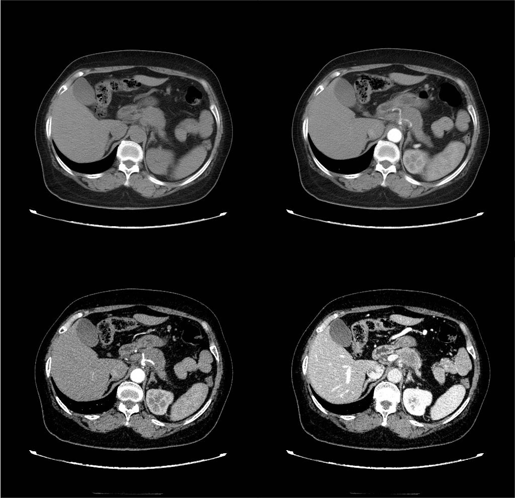 术前增强CT 术前增强CT